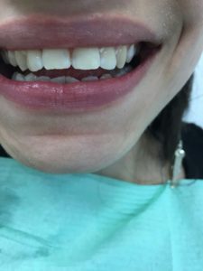 Отбеливание зубов и устранение диастемы